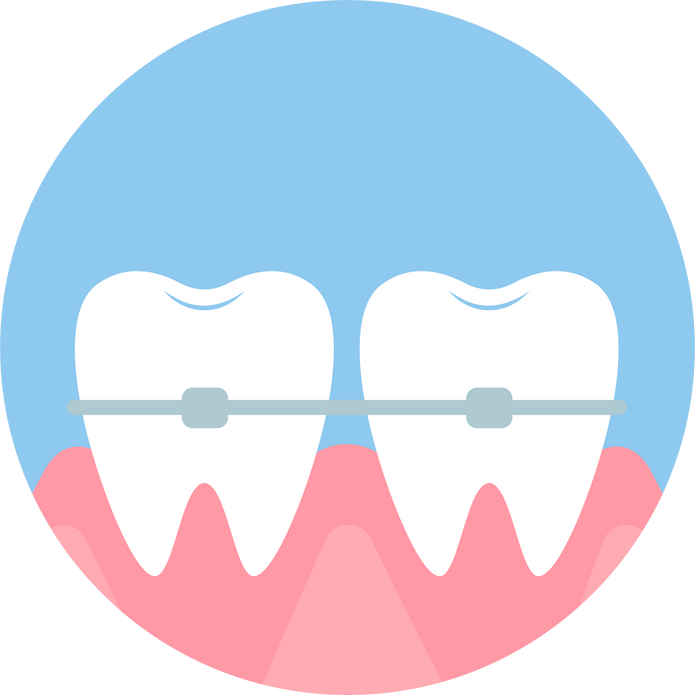 Installing braces illustration