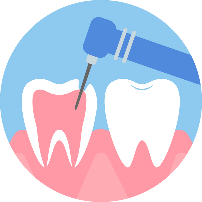 Pulpitis treatment illustration