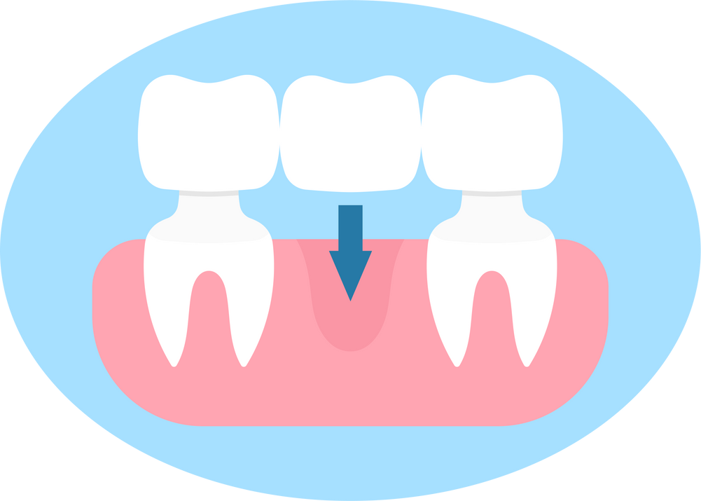 dental bridge teeth missing bleeding gum recession erosion damage fillings false supporting abutment