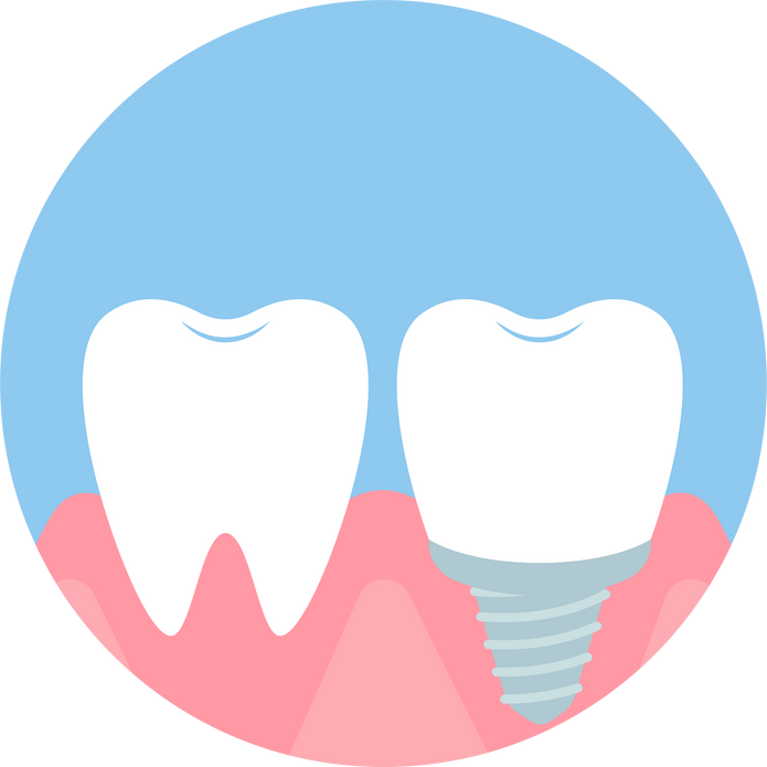 Implant installation illustration